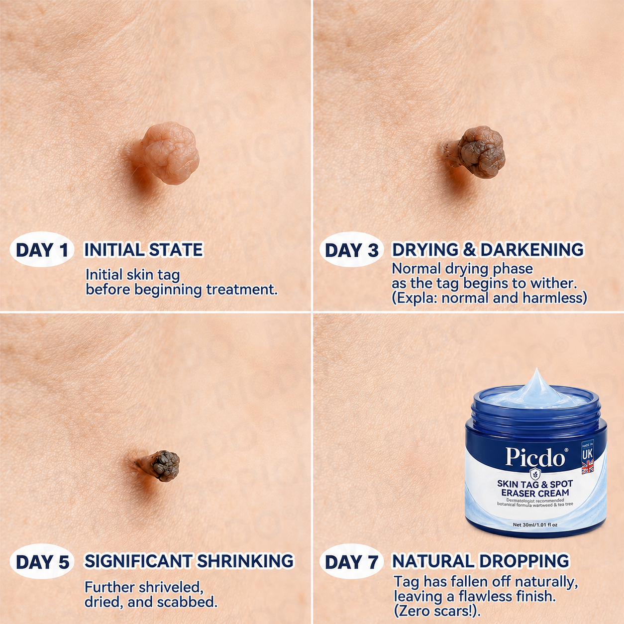 𝐏𝐢𝐜𝐝𝐨® 🧑‍⚕️ 7-𝐃𝐚𝐲 𝐒𝐤𝐢𝐧 𝐓𝐚𝐠 & 𝐒𝐩𝐨𝐭 𝐄𝐫𝐚𝐬𝐞𝐫 𝐂𝐫𝐞𝐚𝐦(Zero Pain, Zero 𝐒𝐜𝐚𝐫𝐬 Formula) 💦