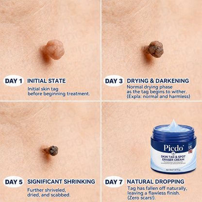 𝐏𝐢𝐜𝐝𝐨® 🧑‍⚕️ 7-𝐃𝐚𝐲 𝐒𝐤𝐢𝐧 𝐓𝐚𝐠 & 𝐒𝐩𝐨𝐭 𝐄𝐫𝐚𝐬𝐞𝐫 𝐂𝐫𝐞𝐚𝐦(Zero Pain, Zero 𝐒𝐜𝐚𝐫𝐬 Formula) 💦