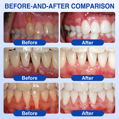 🇬🇧Glimmerly® 🦷 GumRevive periodontal repair gel 🧑‍⚕️