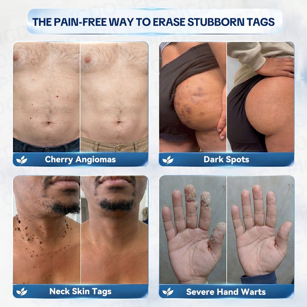 𝐏𝐢𝐜𝐝𝐨® 🧑‍⚕️ 7-𝐃𝐚𝐲 𝐒𝐤𝐢𝐧 𝐓𝐚𝐠 & 𝐒𝐩𝐨𝐭 𝐄𝐫𝐚𝐬𝐞𝐫 𝐂𝐫𝐞𝐚𝐦(Zero Pain, Zero 𝐒𝐜𝐚𝐫𝐬 Formula) 💦