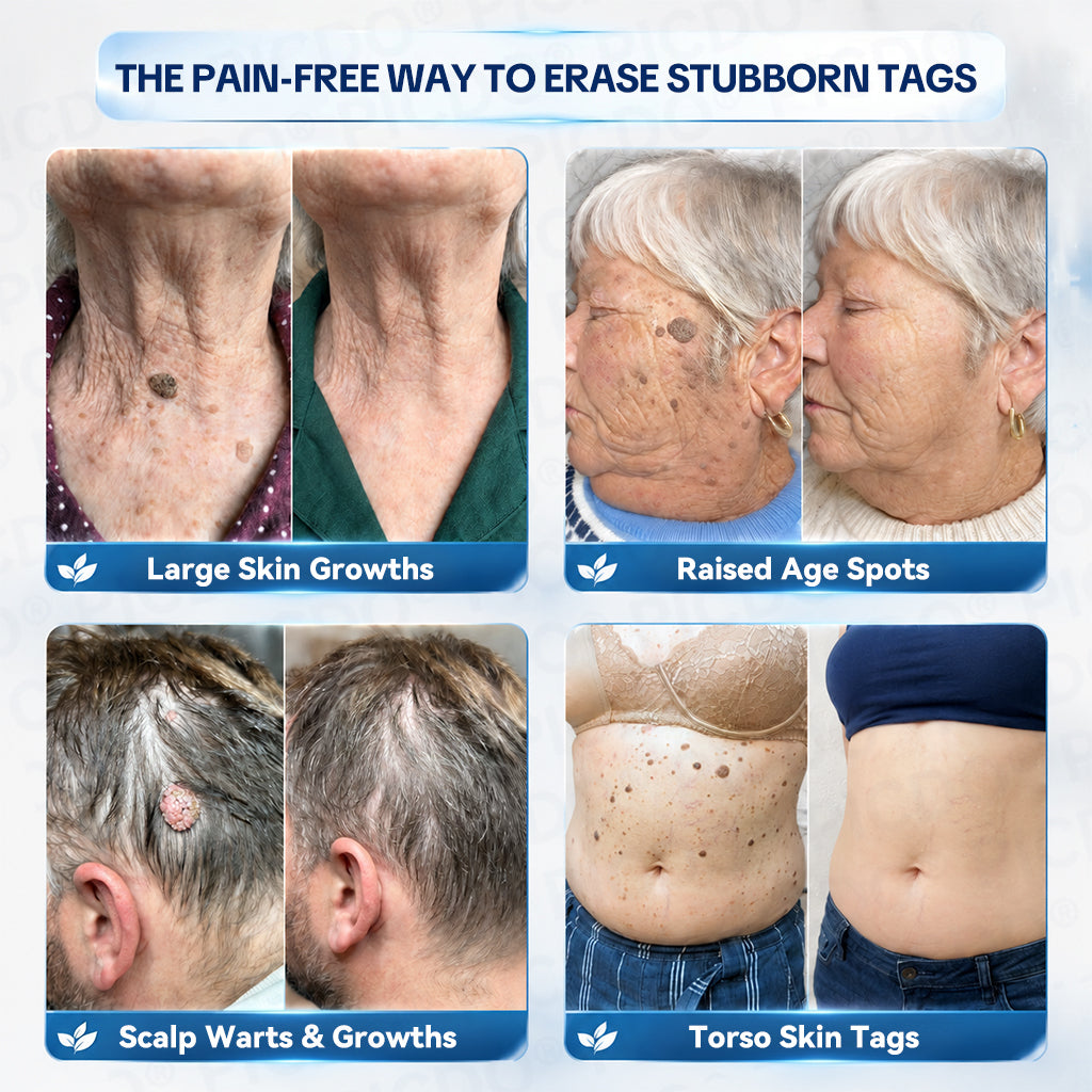 𝐏𝐢𝐜𝐝𝐨® 🧑‍⚕️ 7-𝐃𝐚𝐲 𝐒𝐤𝐢𝐧 𝐓𝐚𝐠 & 𝐒𝐩𝐨𝐭 𝐄𝐫𝐚𝐬𝐞𝐫 𝐂𝐫𝐞𝐚𝐦(Zero Pain, Zero 𝐒𝐜𝐚𝐫𝐬 Formula) 💦