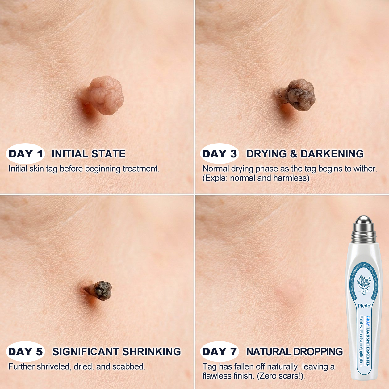 𝐏i𝐜𝐝o® 7-𝐷𝑎𝑦 𝗧𝐚𝐠 & 𝗦𝗽𝐨𝐭 𝐄𝐫𝒂𝒔𝒆𝒓(Zero Pain, Zero 𝐒𝐜𝐚𝒓𝒔 Rollerball) ☀️