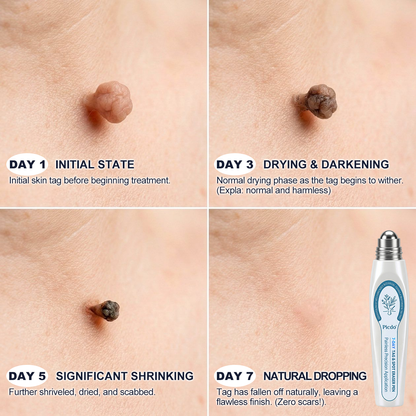𝐏i𝐜𝐝o® 7-𝐷𝑎𝑦 𝗧𝐚𝐠 & 𝗦𝗽𝐨𝐭 𝐄𝐫𝒂𝒔𝒆𝒓(Zero Pain, Zero 𝐒𝐜𝐚𝒓𝒔 Rollerball) ☀️